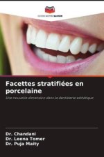 Facettes stratifiées en porcelaine