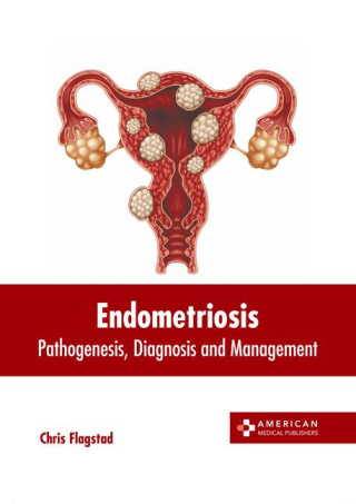 Endometriosis: Pathogenesis, Diagnosis and Management