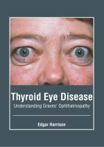 Thyroid Eye Disease: Understanding Graves' Ophthalmopathy