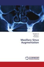 Maxillary Sinus Augmentation