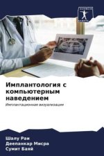 Implantologiq s komp'üternym nawedeniem