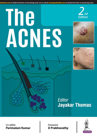 Acnes