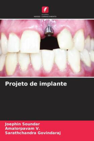 Projeto de implante