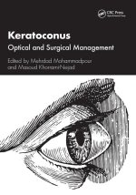 Keratoconus