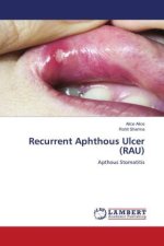 Recurrent Aphthous Ulcer (RAU)