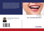 SELF LIGATING BRACKETS