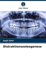 Distraktionsosteogenese