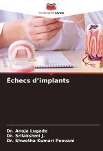 Échecs d?implants