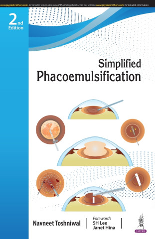 Simplified Phacoemulsification