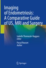 Imaging of Endometriosis: A Comparative Guide of US, MRI and Surgery