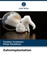 Zahnimplantation