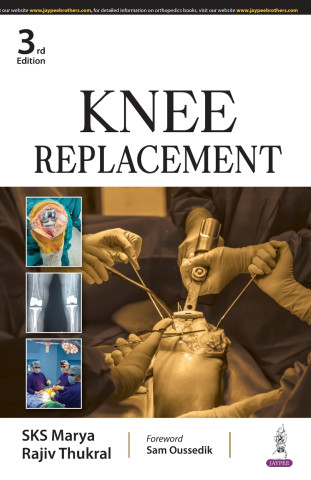 Knee Replacement