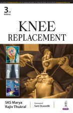 Knee Replacement