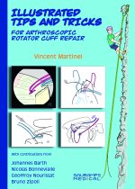Illustrated tips & tricks for arthroscopic rotator cuff repair