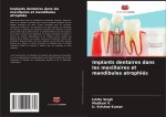Implants dentaires dans les maxillaires et mandibules atrophiés