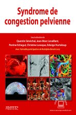 Syndrome de congestion pelvienne
