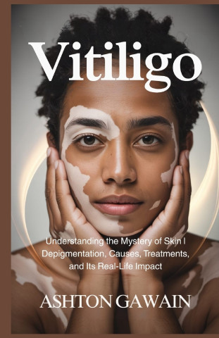 Vitiligo