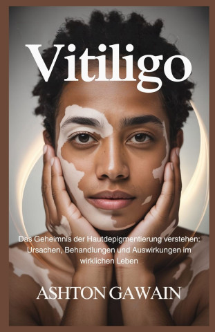 Vitiligo