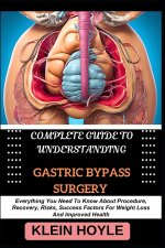 COMPLETE GUIDE TO UNDERSTANDING GASTRIC BYPASS SURGERY