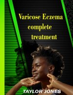 Varicose eczema Complete treatment