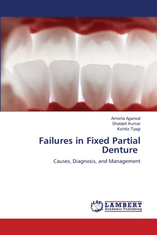 Failures in Fixed Partial Denture