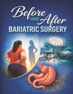 BEFORE AND AFTER BARIATRIC SURGERY
