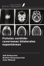 Fístulas carótido-cavernosas bilaterales espontáneas